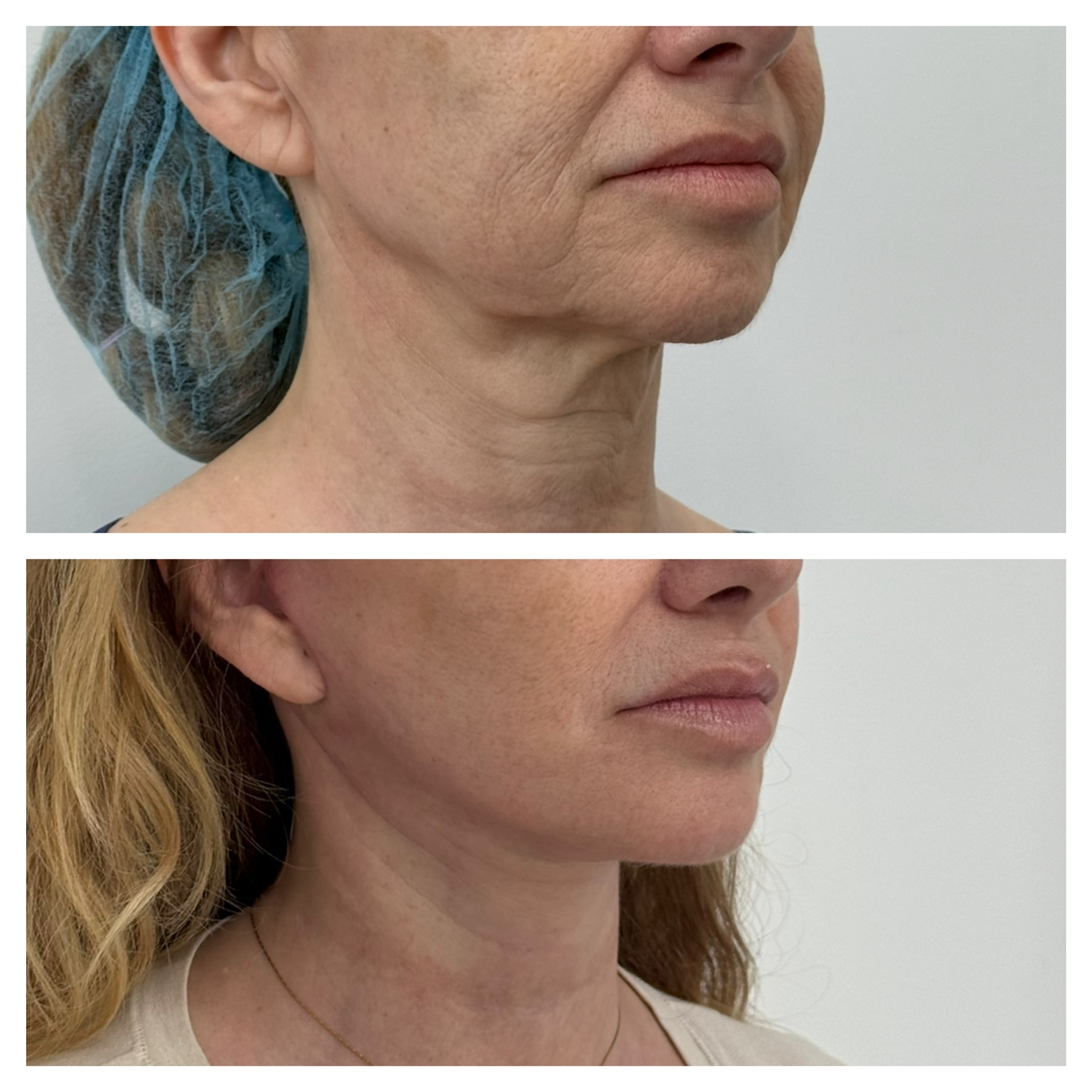 Resultado de lifting facial: Su rostro no reflejaba lo activa que se sentía